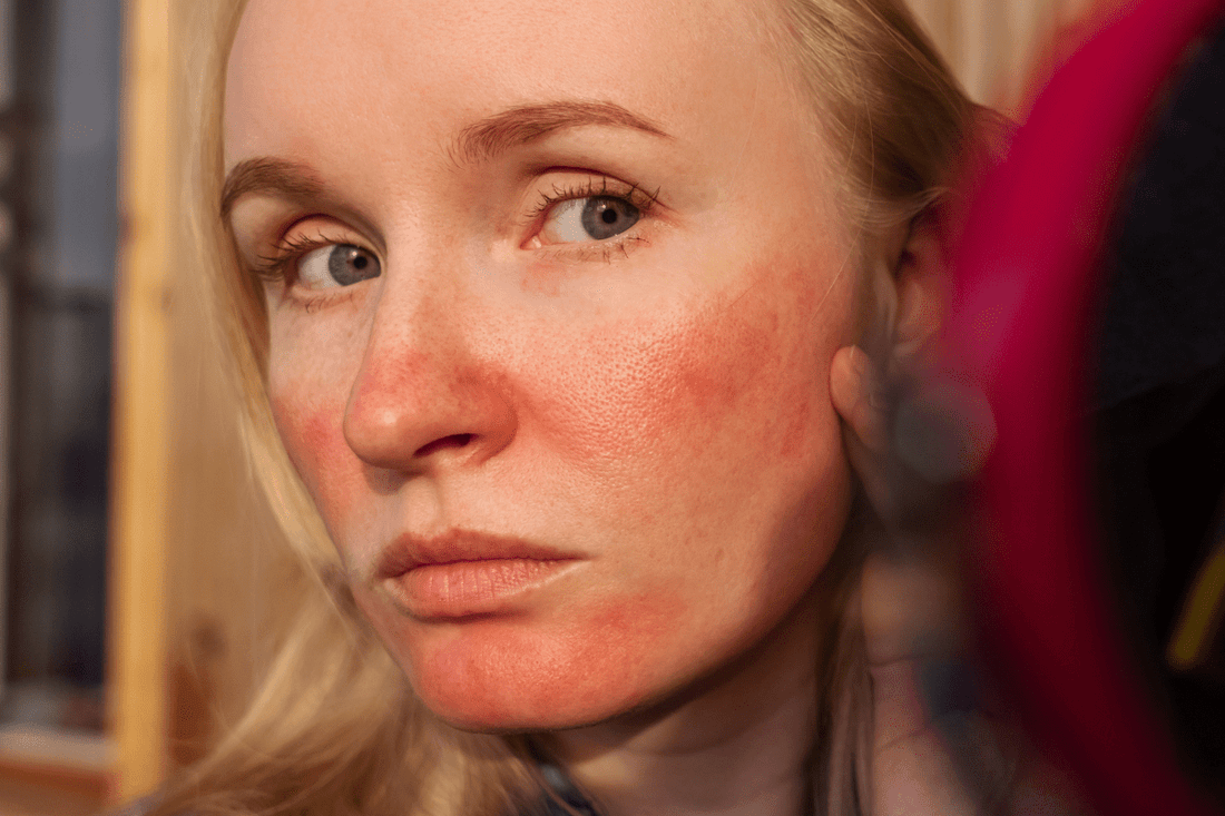 Best Sunscreen for Rosacea: Sky & Sol Buyer Guide - Sky and Sol