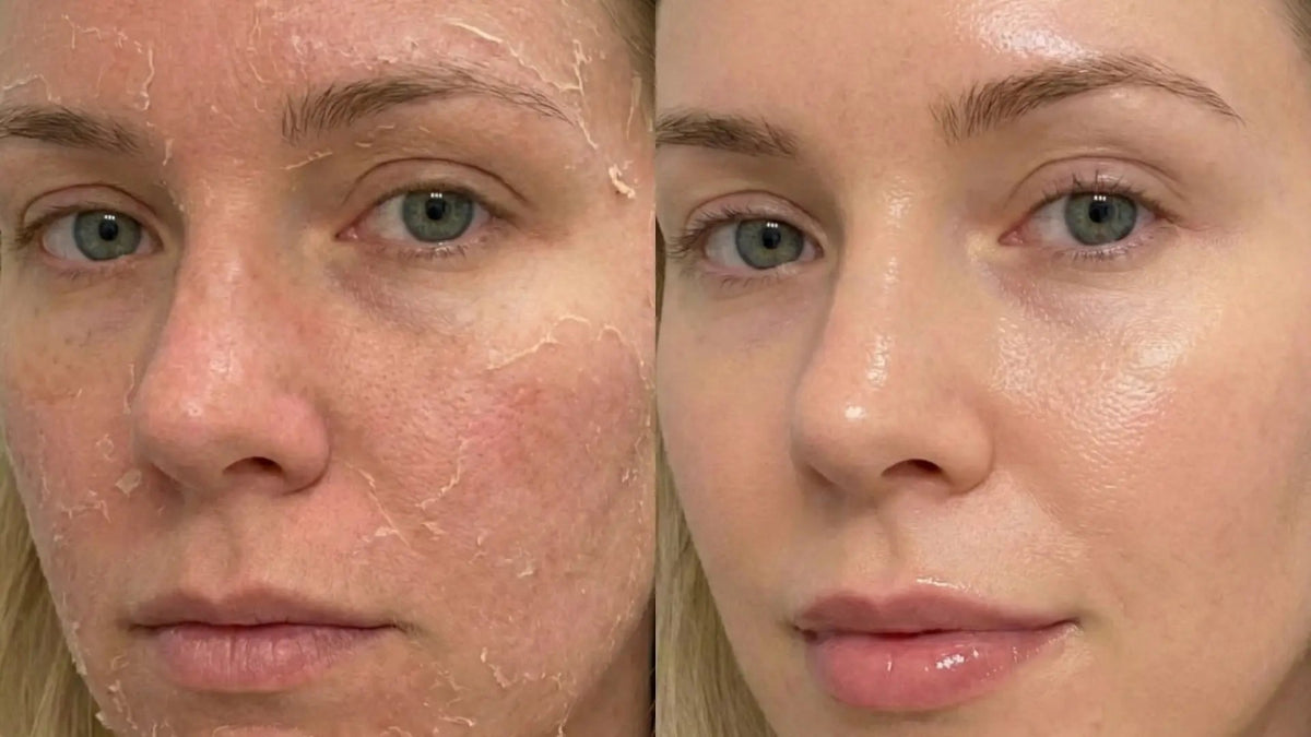 How to Fix Extremely Dry Skin Naturally: A Complete Guide - Sky and Sol