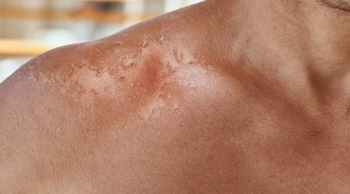 How to Not Get Sunburn: A Comprehensive Guide - Sky and Sol