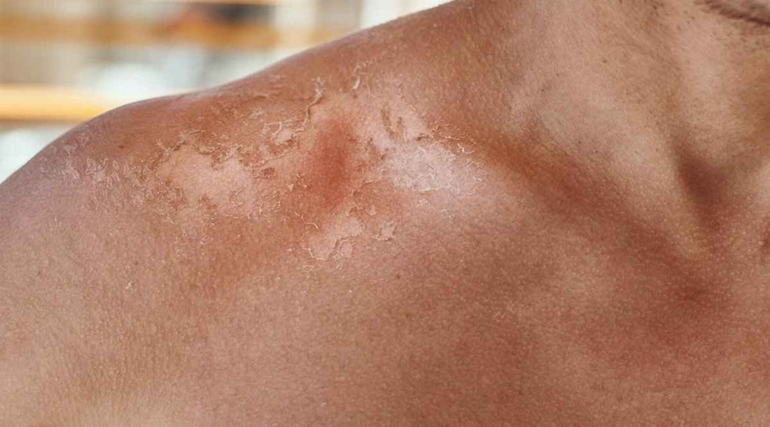 How to Not Get Sunburn: A Comprehensive Guide - Sky and Sol