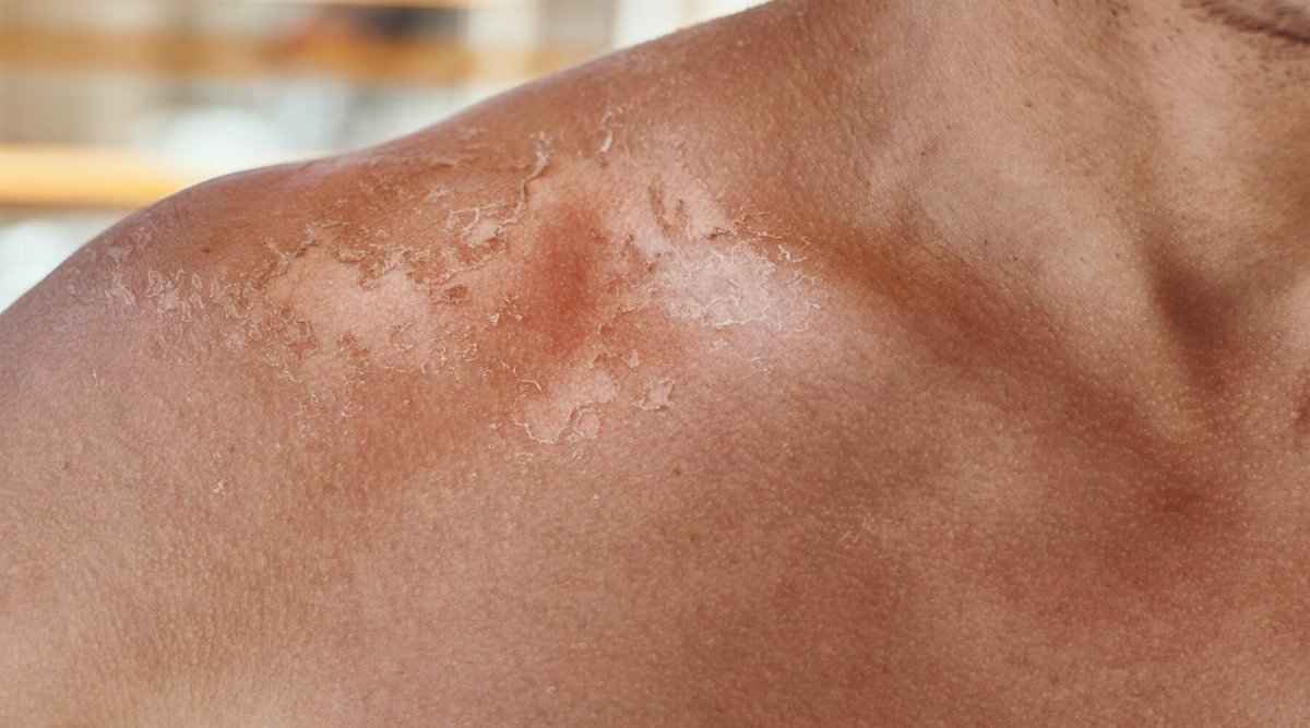 How to Not Get Sunburn: A Comprehensive Guide - Sky and Sol