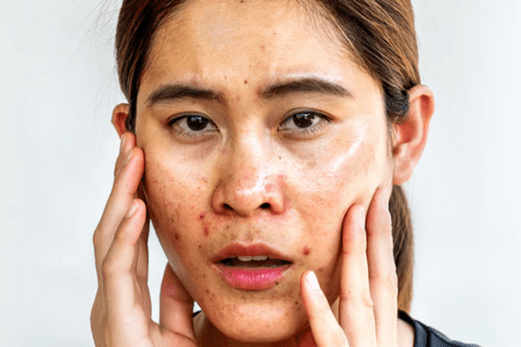 The 5 Best Sunscreens for Oily Skin in 2025 - Sky and Sol